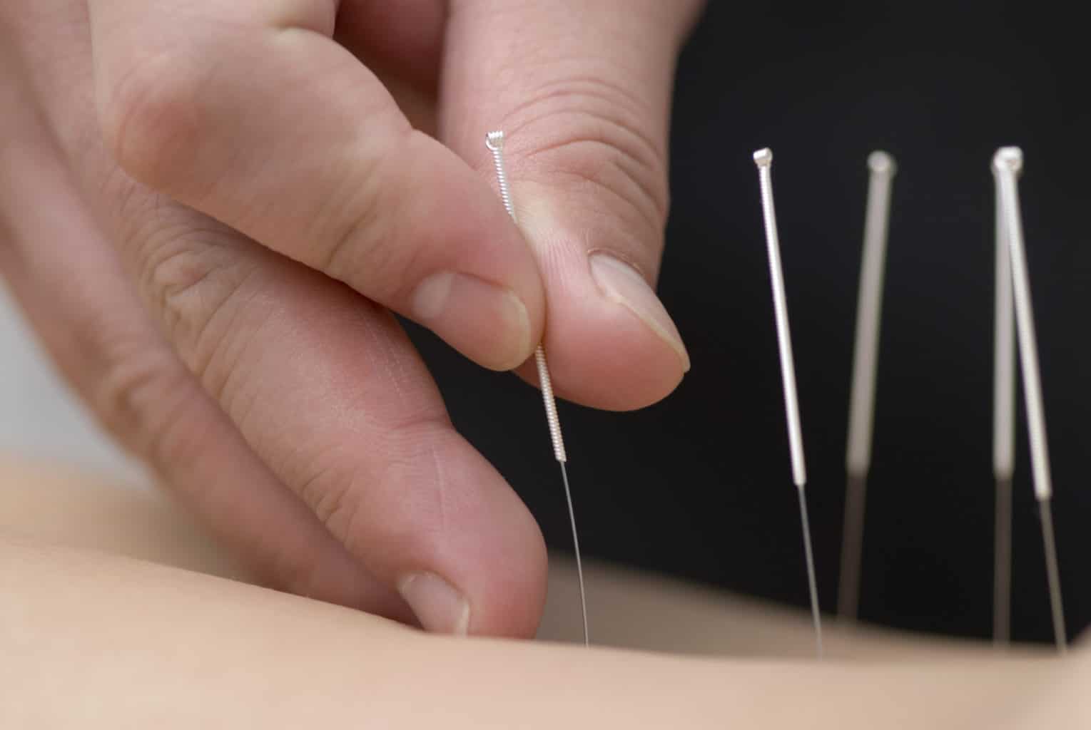 acupuncture-schools